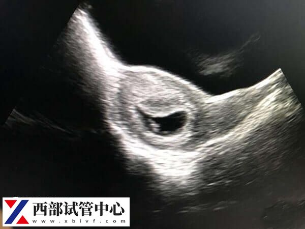 刮宫后多久可以移植胚胎(图1) 胚胎移植前内膜不可过厚