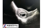 刮宫后多久可以移植胚胎